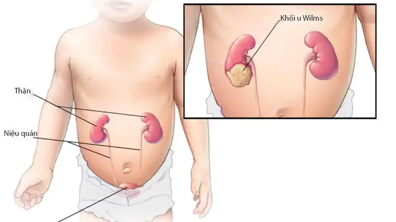 Giới thiệu về u Wilms ở trẻ em và từng giai đoạn của bệnh 1