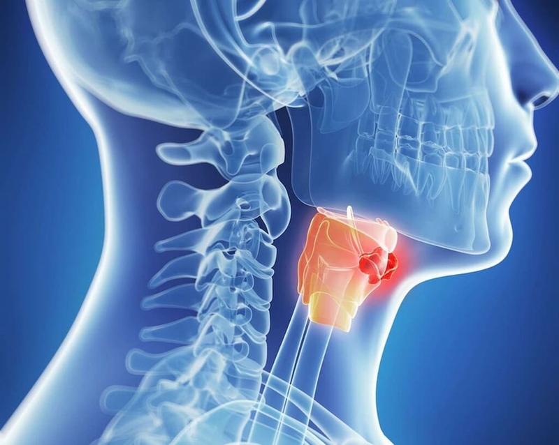 Góc giải đáp: Ung thư hạ họng là gì? Ung thư hạ họng sống được bao lâu? 1