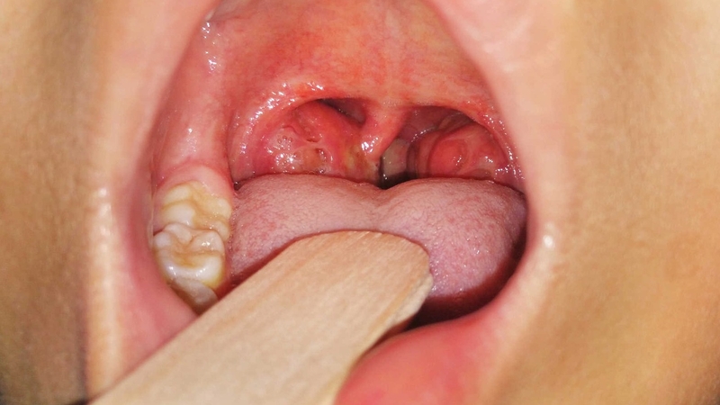 Gợi ý cách chữa viêm họng amidan tại nhà hiệu quả 1