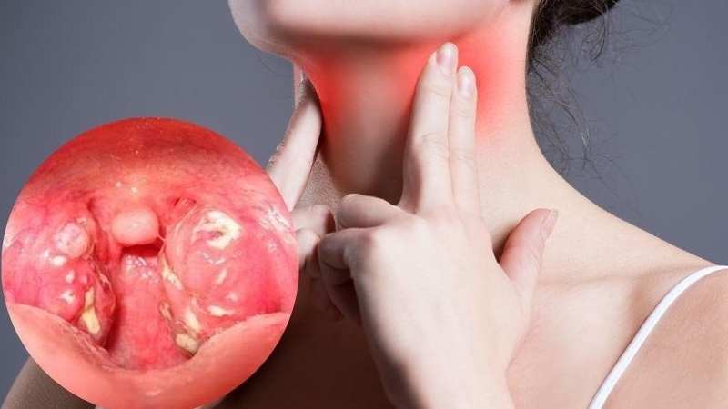 Cách chữa viêm họng amidan tại nhà đơn giản, hiệu quả 2