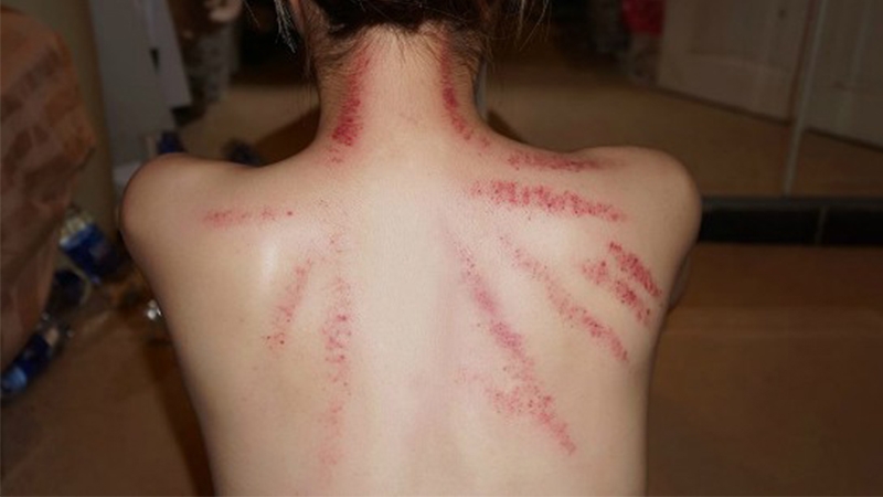 Xem ngay cách đánh cảm bằng dầu gió đảm bảo an toàn và hiệu quả 1