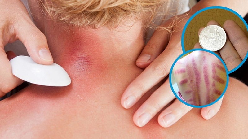 Xem ngay cách đánh cảm bằng dầu gió đảm bảo an toàn và hiệu quả 2