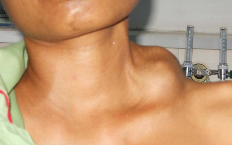 Hạch troisier là gì? Hạch nằm ở đâu và có gây nguy hiểm không? 4