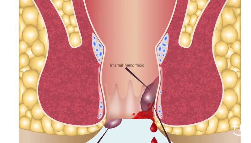 Các cấp độ của bệnh trĩ và cách nhận biết chính xác 2