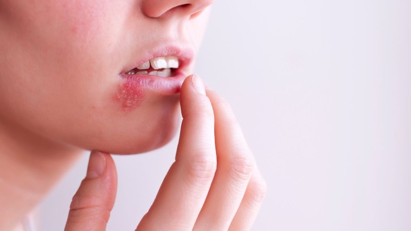 Nhiều người chưa biết&nbsp;Herpes là gì&nbsp;và nguyên nhân gây bệnh ra sao