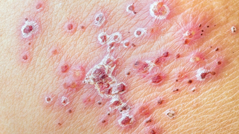 Herpes simplex là bệnh do virus HSV gây ra và có thể tái phát nhiều lần trong đời