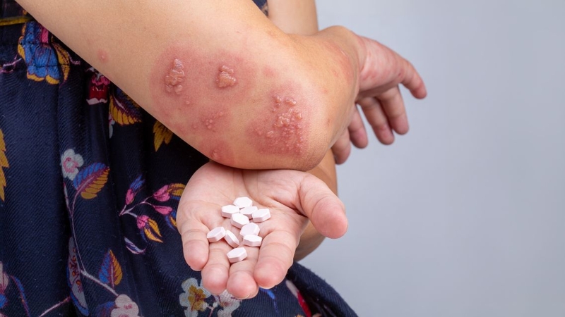 Mụn nước nhỏ mọc thành cụm là dấu hiệu điển hình của bệnh Herpes