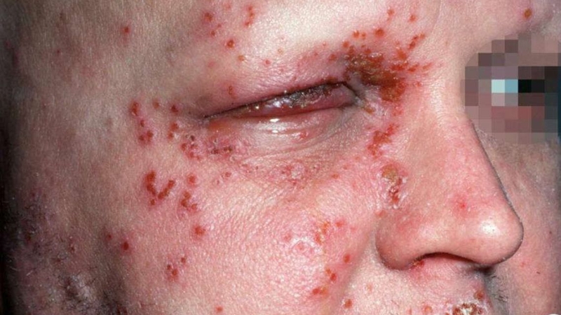 Điều trị sớm bằng thuốc kháng virus giúp giảm triệu chứng và rút ngắn thời gian mắc bệnh