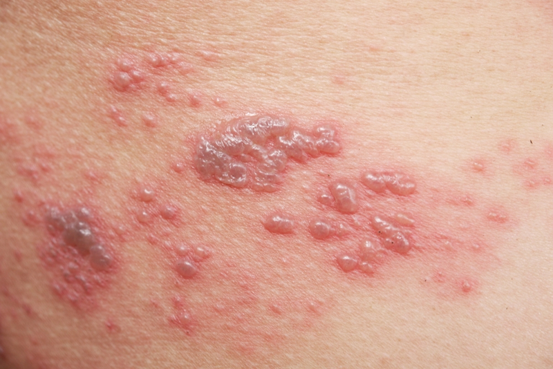 Hình ảnh bệnh zona thần kinh như thế nào?4