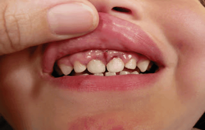 Hình ảnh viêm lợi ở trẻ em 4.png