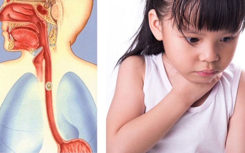 Hóc xương cá uống thuốc gì nhanh khỏi? Những lưu ý khi bị hóc xương cá 1