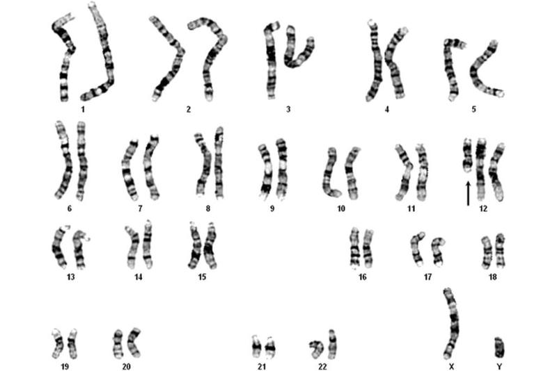 Hội chứng Pallister - Killian: Triệu chứng, phương pháp chẩn đoán và cách điều trị
