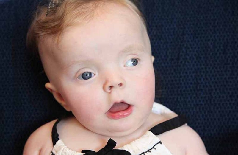 Hội chứng Pallister - Killian: Triệu chứng, phương pháp chẩn đoán và cách điều trị