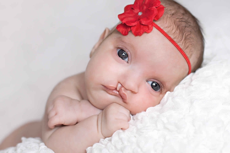 Hội chứng Wolf - Hirschhorn: Nguyên nhân, triệu chứng, phương pháp chẩn đoán và điều trị 1