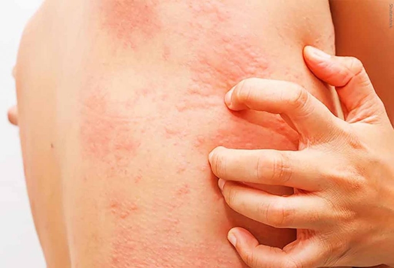 Hội chứng hồng ban nút (erythema nodosum) 3