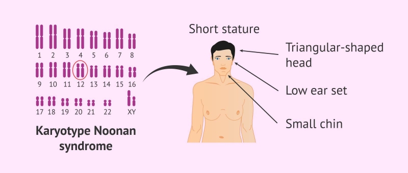 Hội chứng noonan là gì? Nguyên nhân, triệu chứng và cách điều trị