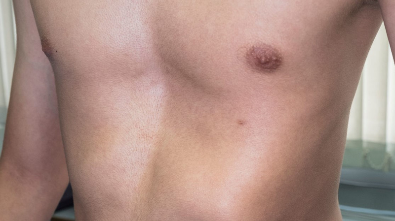 Hội chứng poland là gì? Triệu chứng và cách điều trị 2