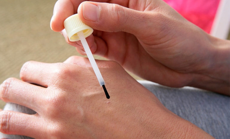 Hỏi đáp Cách trị mụn cóc bằng axit có hiệu quả hay không 3