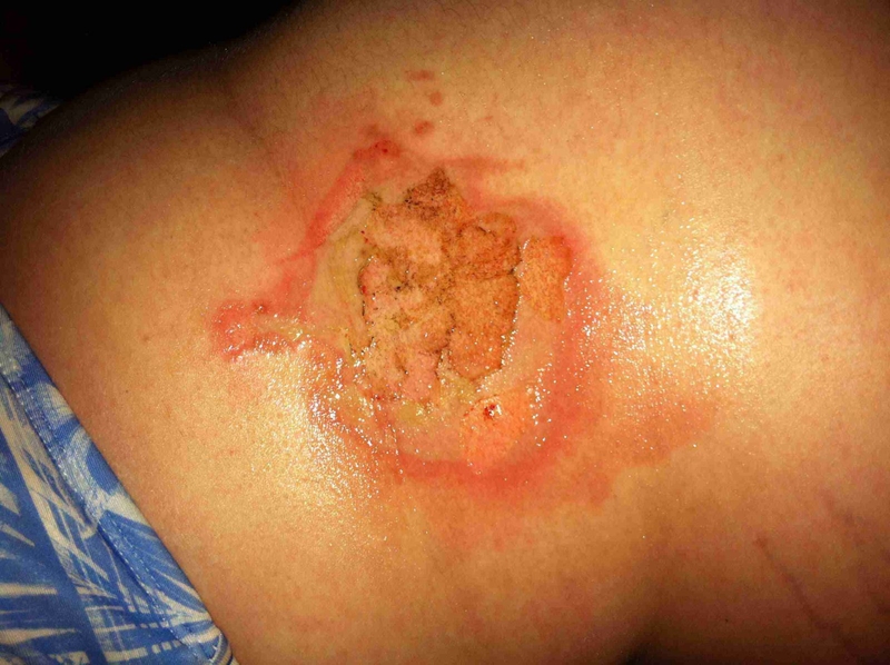 Hướng dẫn sơ cứu phỏng dầu đúng cách 4