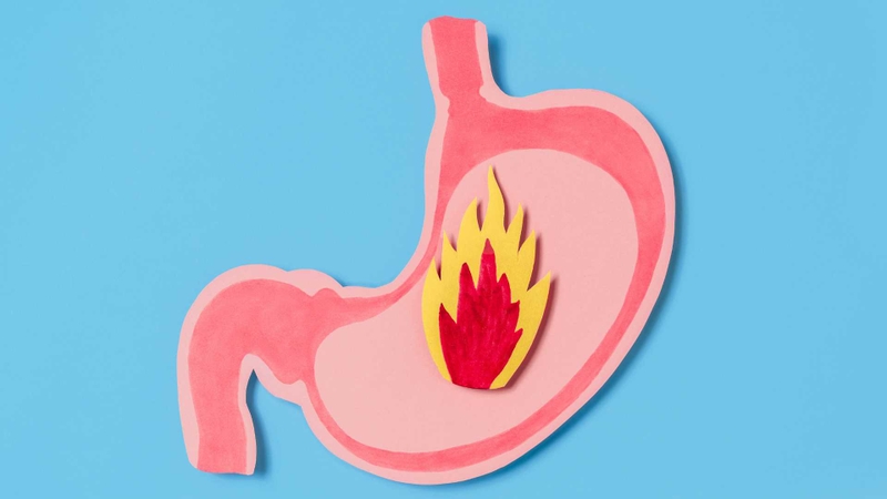 Trào ngược dạ dày xảy ra khi acid từ dạ dày trào ngược lên thực quản