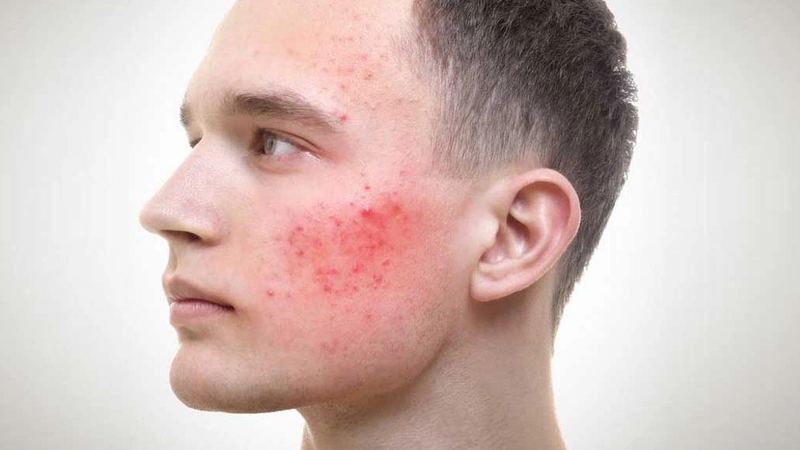 Hút pod có nổi mụn không? Cách điều trị mụn do hút pod 3