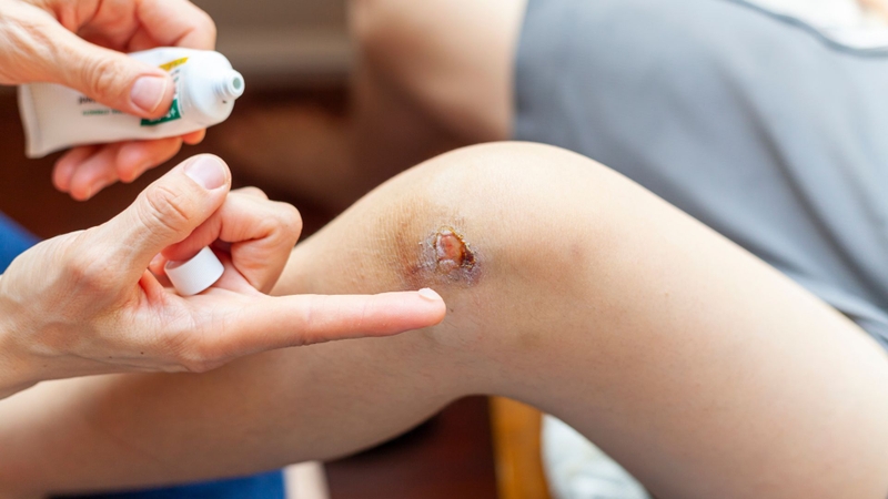 Iodoform thường có mặt trong thuốc bôi vết loét, vết bỏng, áp xe, hoặc mô hoại tử để hỗ trợ làm sạch mô chết