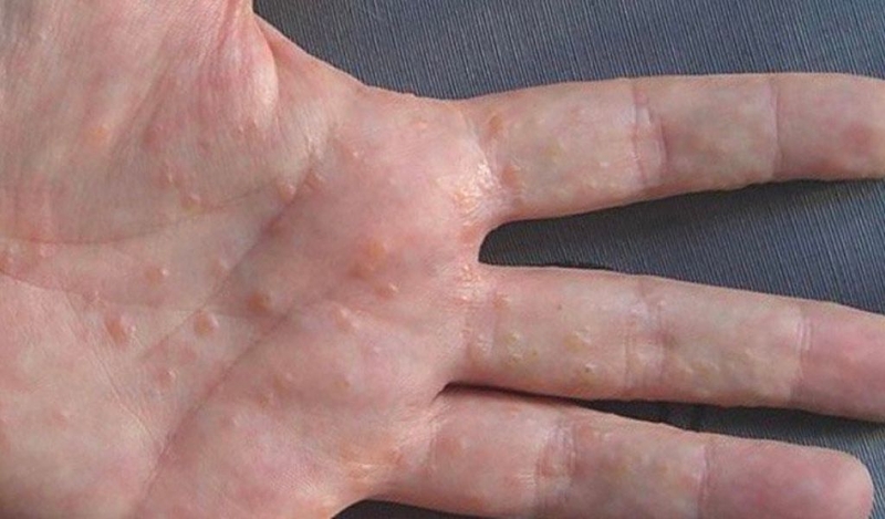 Cách xử lý nổi mụn nước ở lòng bàn tay tại nhà hiệu quả như thế nào? 1
