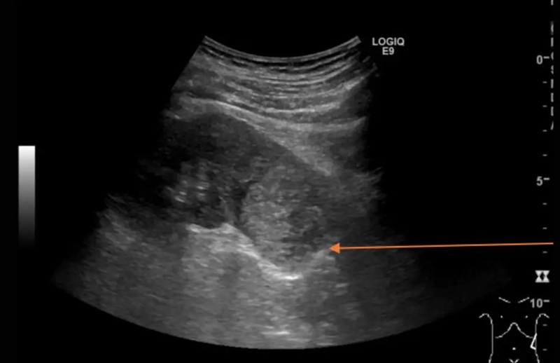 Kích thước bình thường của thận 02