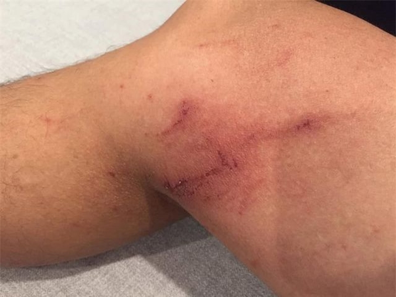 Tác hại của kiến ba khoang đối với con người khi bị đốt2