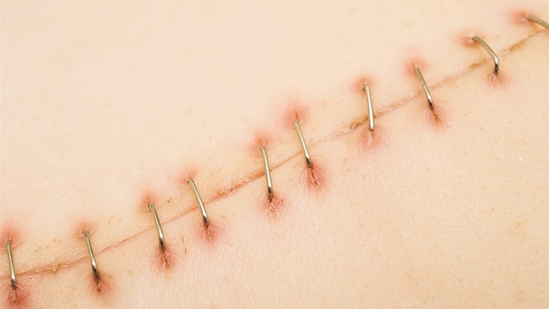 L-Arginine giúp tăng tốc độ lành vết thương trên cơ thể