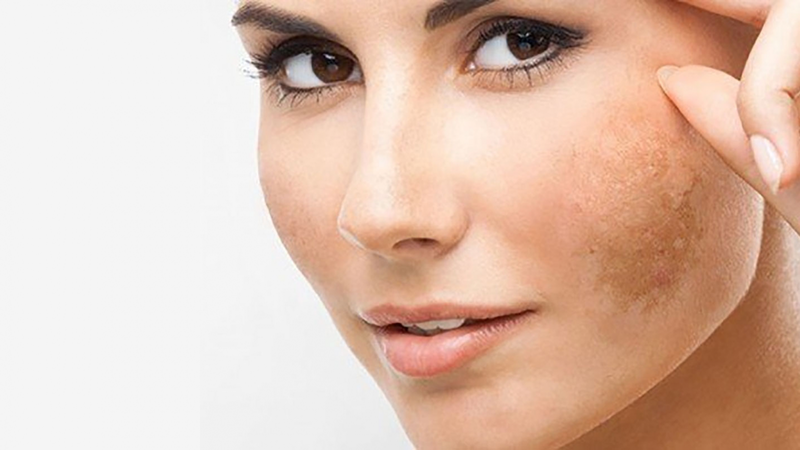 Liệt kê các nguyên nhân gây nám da ở chị em 2