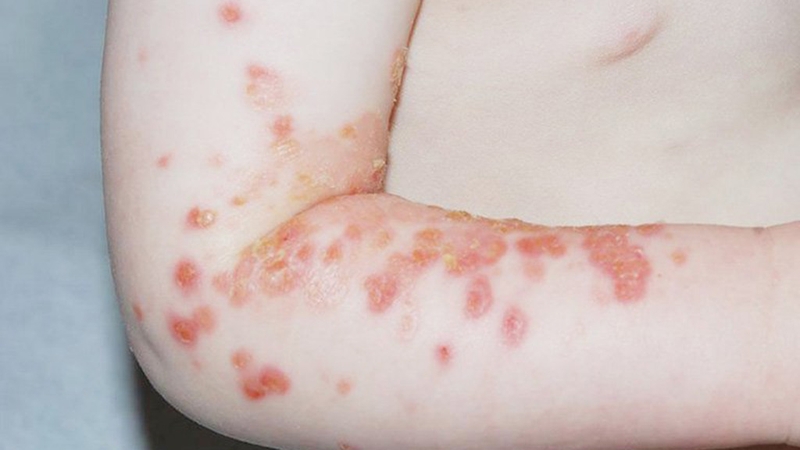 Liệu rằng bệnh chốc lở ở trẻ em có lây không 2