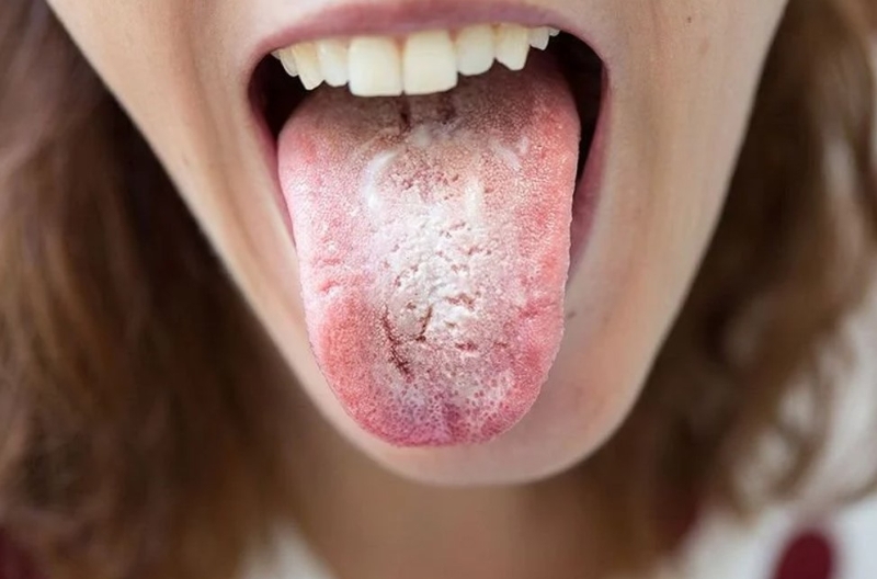 Lưỡi có đốm trắng 01