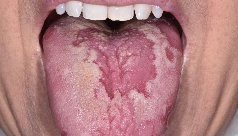 Lưỡi có đốm trắng 02