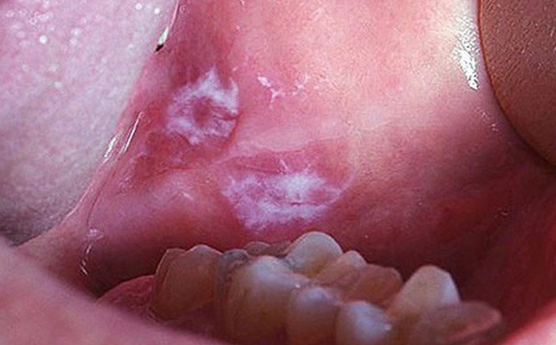 Lưỡi có đốm trắng 03