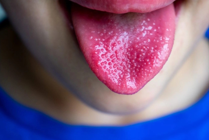 Lưỡi dâu tây 01