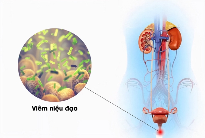 Lý giải vì sao viêm niệu đạo dễ tái phát 2
