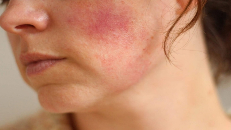 Mách bạn cách chăm sóc da nhạy cảm để tránh bị kích ứng, tổn thương da 1