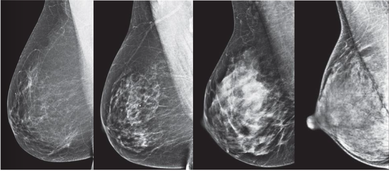 Mật độ mô vú (hay còn gọi là mật độ nhũ ảnh) mô tả hình ảnh vú trên phim chụp tuyến vú 1