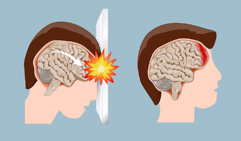 Mất ngôn ngữ là gì? Nguyên nhân và cách điều trị mất ngôn ngữ 2