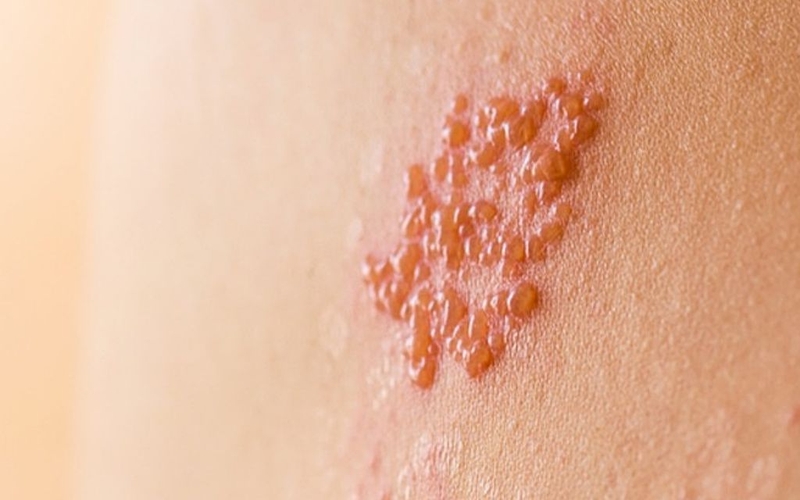 Mẹ bầu bị zona thần kinh bôi thuốc gì để nhanh khỏi và an toàn cho mẹ và bé? 1