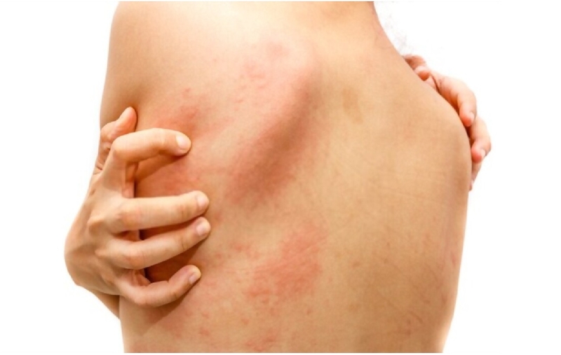 Mề đay sắc tố là gì? 3