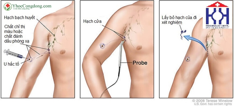 Các phương pháp điều trị ung thư hắc tố3
