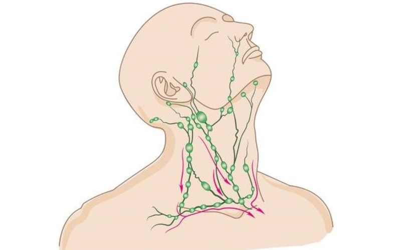 Mổ hạch ở cổ có nguy hiểm không? Lưu ý và các biến chứng sau mổ hạch 3