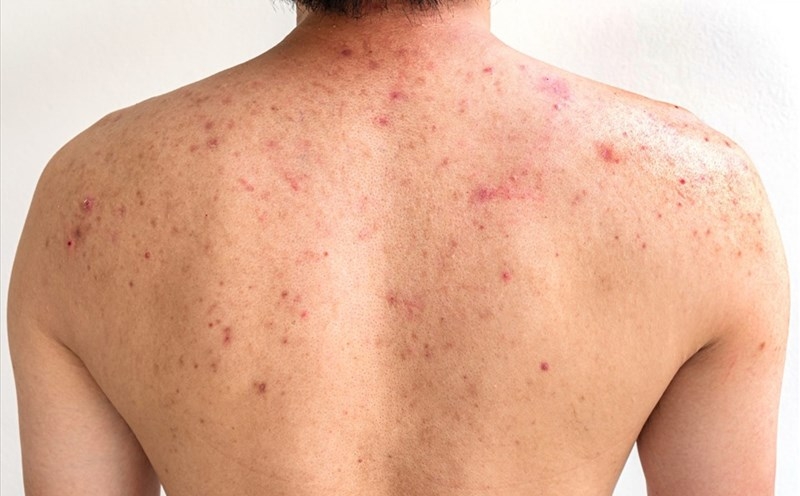 Gynofar trị mụn lưng có hiệu quả không? Có nên áp dụng không? 2