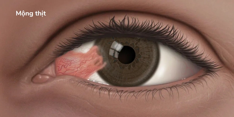Mộng thịt ở mắt và cách điều trị bệnh an toàn, hiệu quả 2.jpg