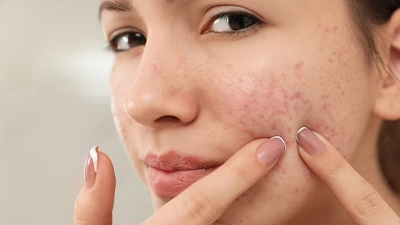 Một số yếu tố dễ khiến mụn quay trở lại trên da mặt 1