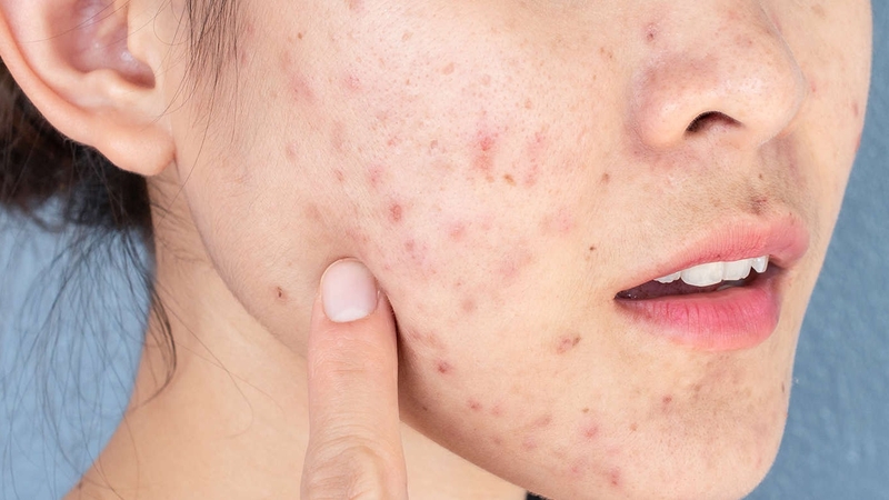 Mụn nội tiết là gì? Nguyên nhân, nhận biết và cách điều trị 2