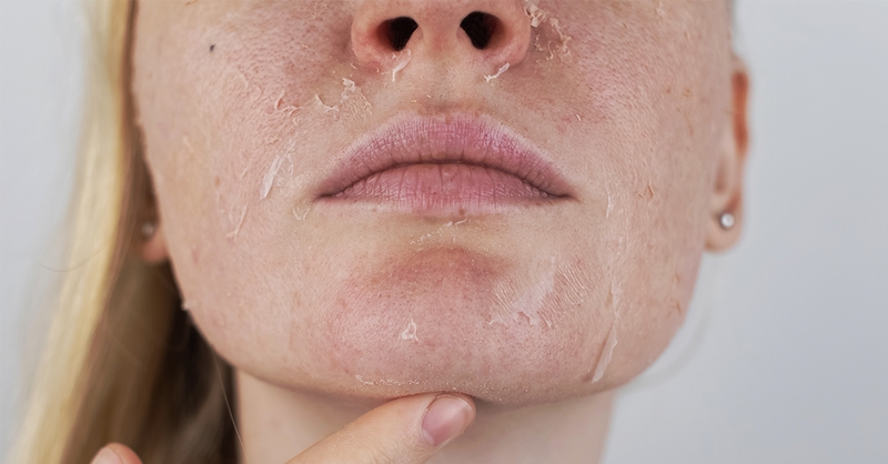 Càng rửa mặt, da càng bong tróc - Nguyên nhân vì sao? 1