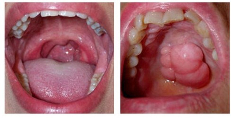 Tìm hiểu chung về ung thư xoang miệng2